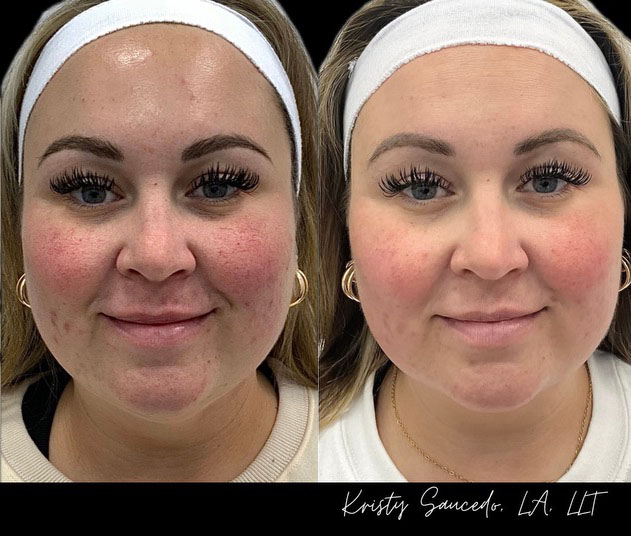 V-Beam® before and after photo by Elite Dermatology & Plastic Surgery in Houston, TX
