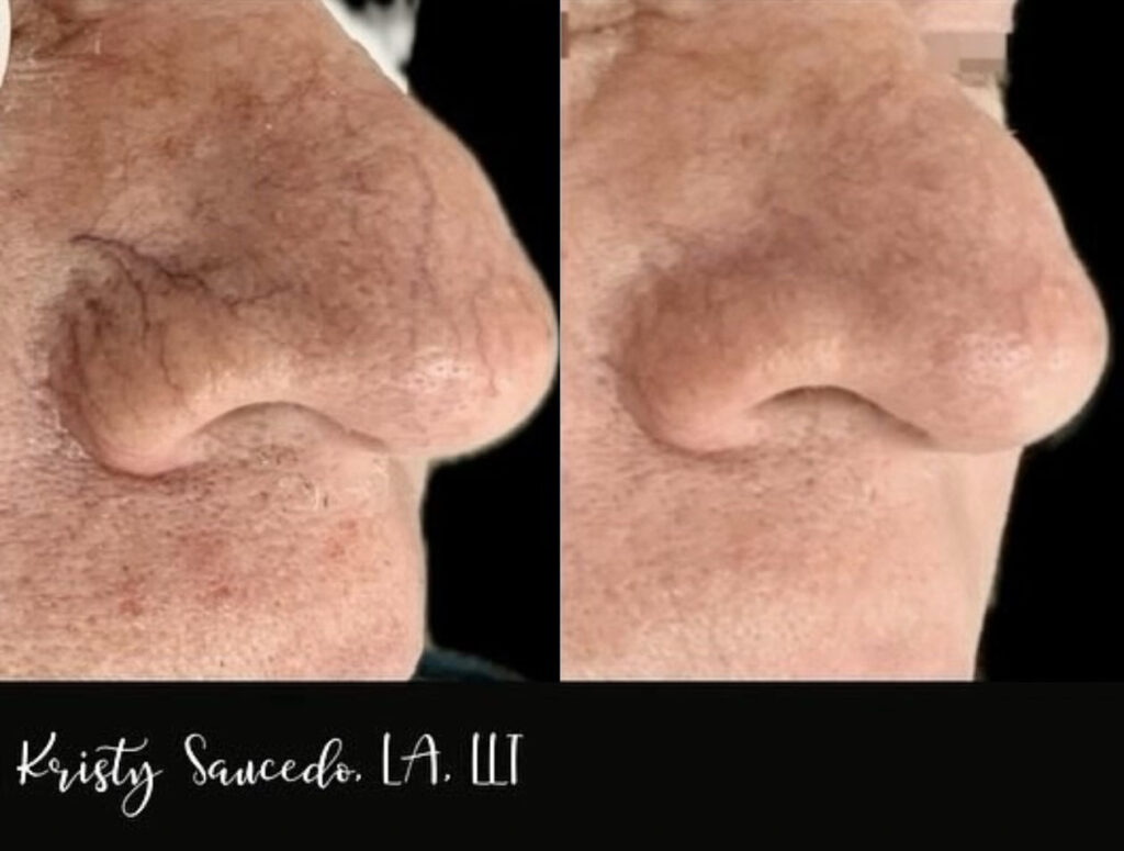 V Beam® before and after photo by Elite Dermatology & Plastic Surgery in Houston, TX