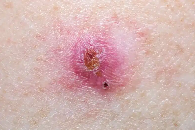 Basal Cell Carcinoma on a mature female content image