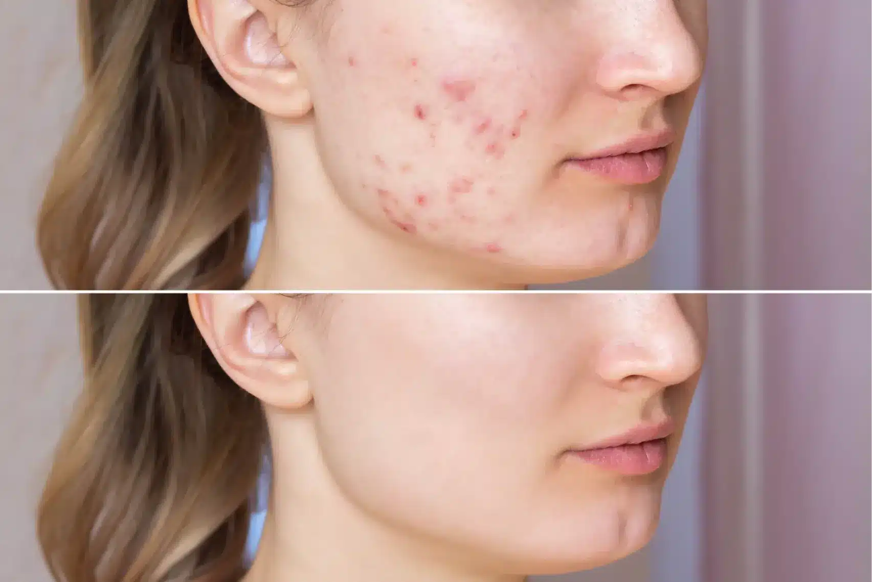 Cropped shot of a young woman's face before and after acne treatment on face acne content image