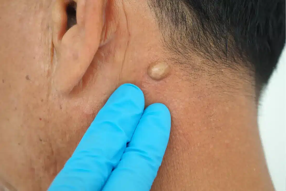 Man pointed to sebaceous cysts on his neck, formed by sebaceous glands cyst content image