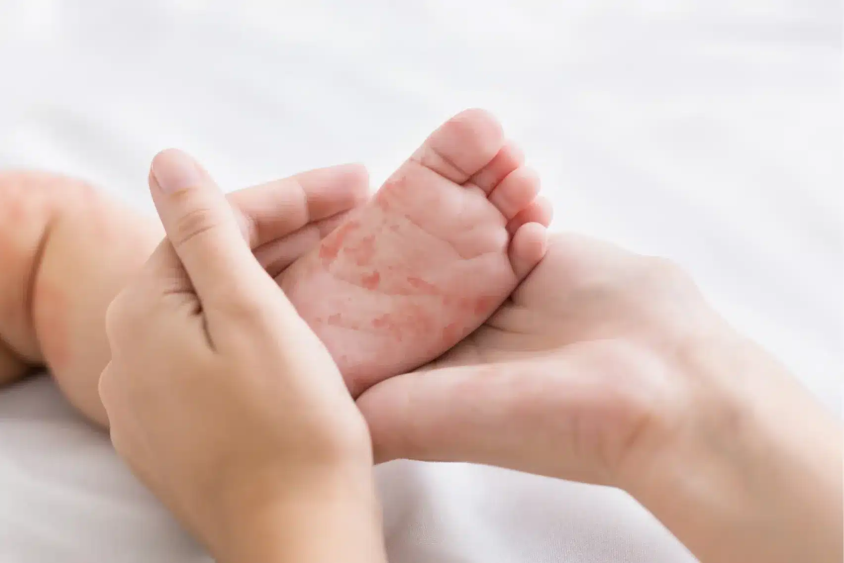 Mother holding tiny baby foot with measles rash pediatric dermatology content image