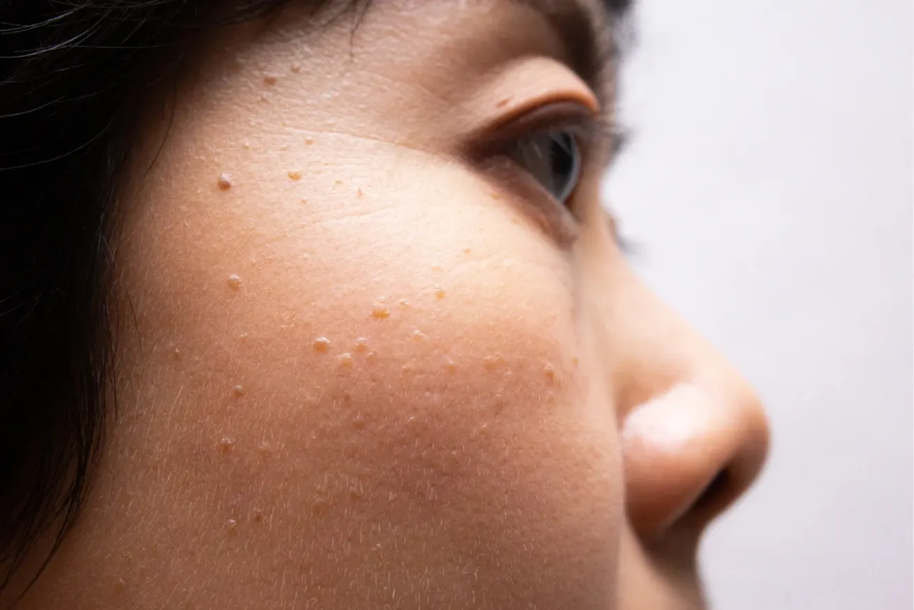 Seborrheic Keratosis, TX | Elite Dermatology & Plastic Surgery