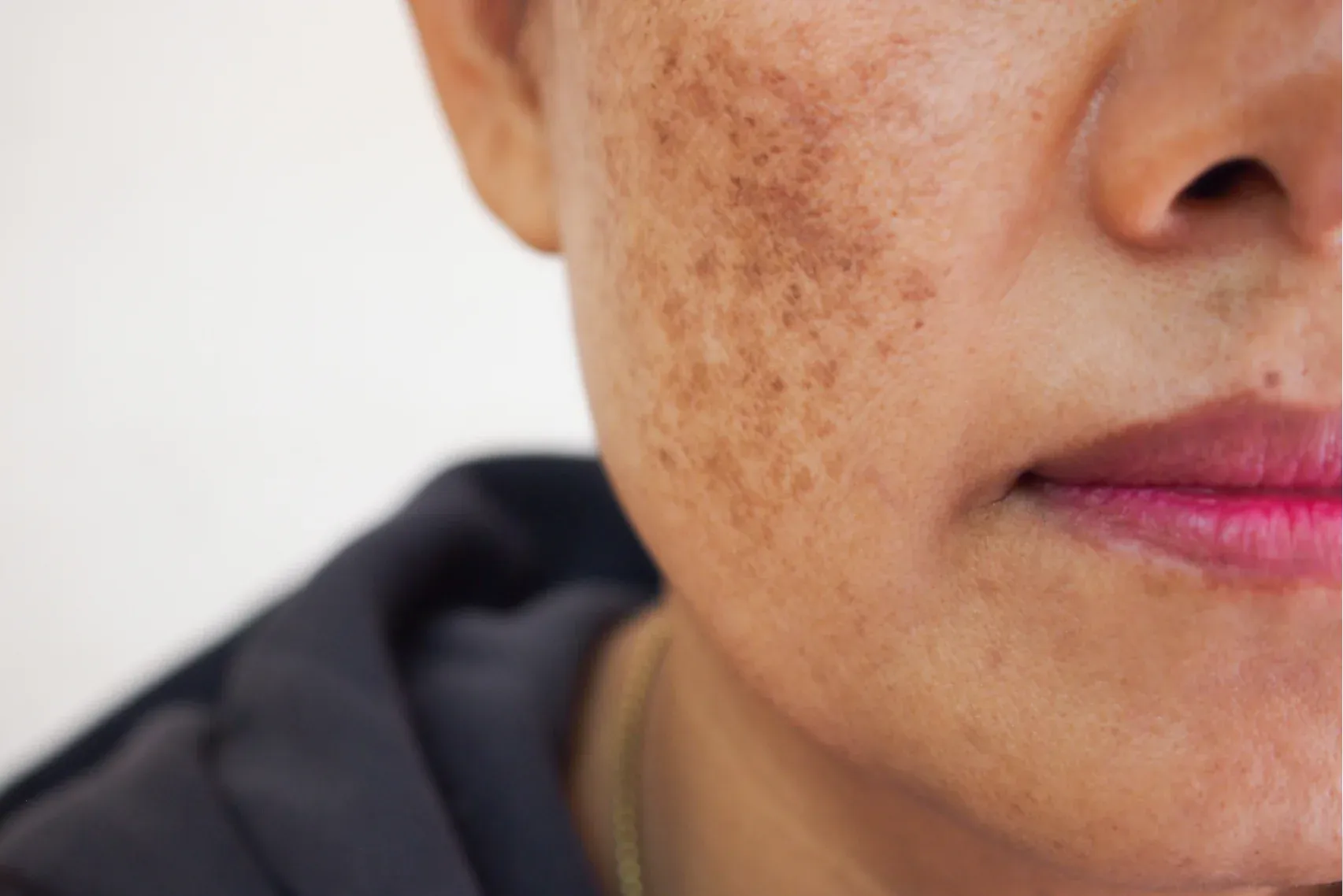 Melasma Treatment, Texas | Elite Dermatology & Plastic Surgery