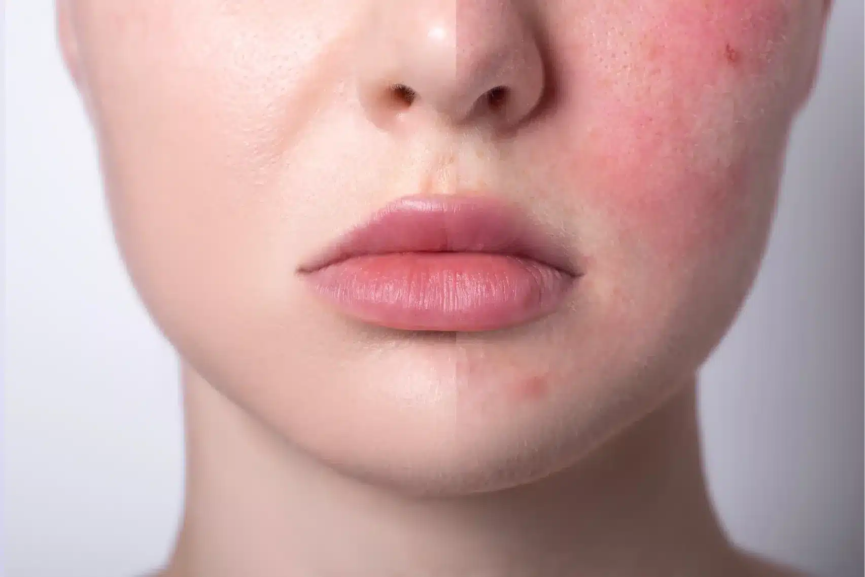 woman with rosacea content image